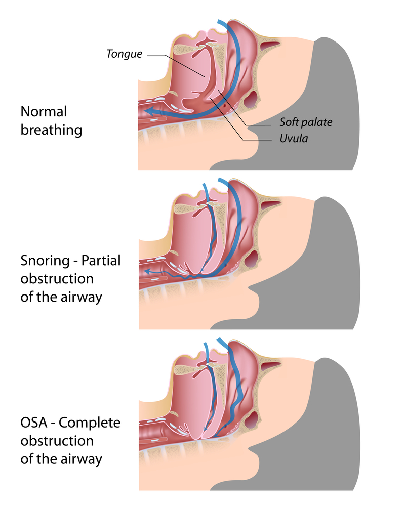 signs-and-symptoms-of-sleep-apnea-wellell