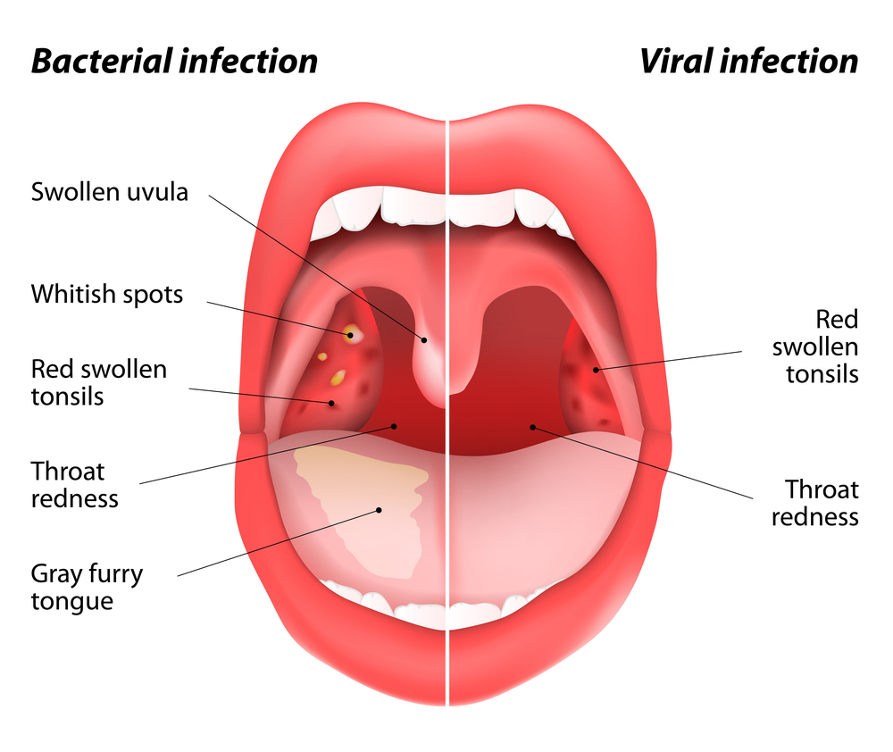 Tonsil Problems Andrew Foreman ENT